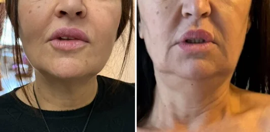 Photo avant/après d'un soin HIFU double menton et visage : réduction visible du double menton