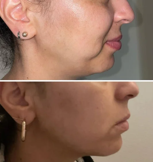Avant/après HIFU double menton et visage : profil affiné, ovale et menton retendus